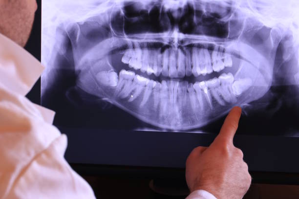 Best Emergency Tooth Extraction in Sugar Grove, IL