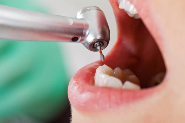 Best Emergency Dental Care for Broken or Chipped Teeth in Sugar Grove, IL